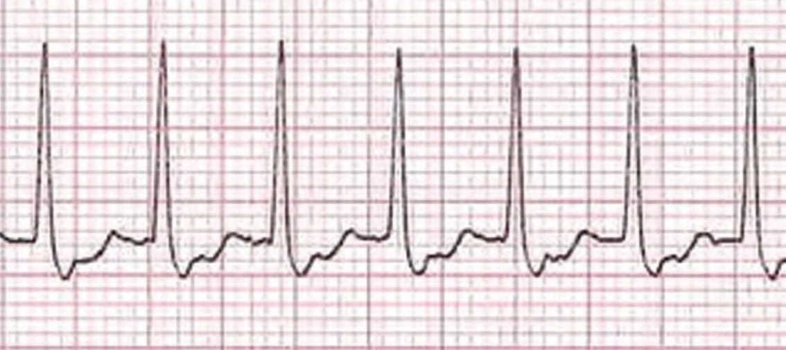 Heart Rhythm Disorders | Dr Riyaz Somani